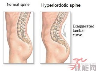 hyperlordosis.jpg