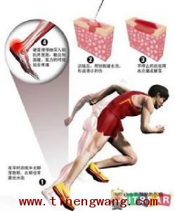 跟腱炎的治疗和康复训练-第4张图片-体能网 跟腱炎的治疗和康复训练-第4张图片-体能网