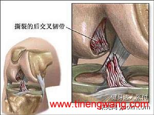 跟腱断裂，韧带断裂与开放性骨折辨析-第2张图片-体能网