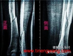 跟腱断裂，韧带断裂与开放性骨折辨析-第4张图片-体能网