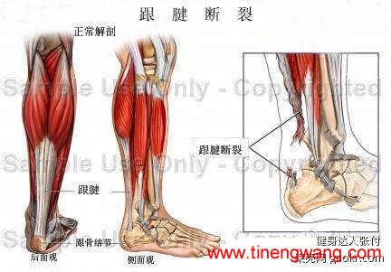 跟腱断裂，韧带断裂与开放性骨折辨析-第1张图片-体能网