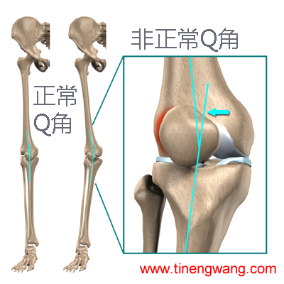 跑步膝的形成因素与预防措施-第5张图片-体能网 跑步膝的形成因素与预防措施-第5张图片-体能网