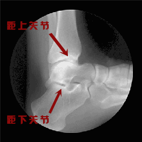 膝盖疼？先查查你的脚是否有问题！-第2张图片-体能网