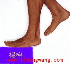 足底筋膜炎-第2张图片-体能网 足底筋膜炎-第2张图片-体能网