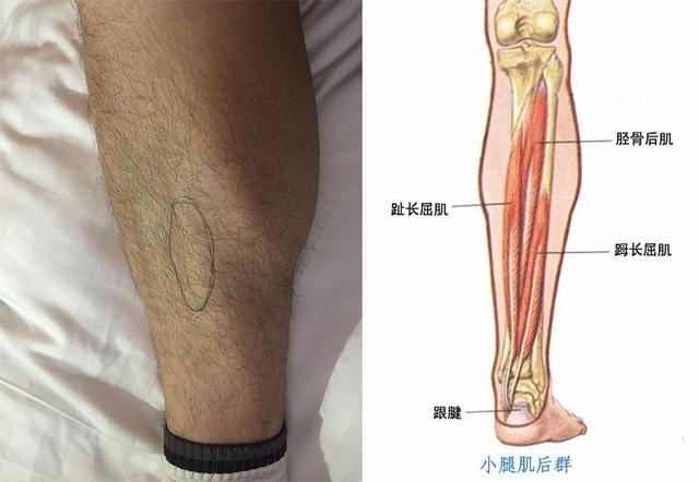 跟腱痛的康复训练和治疗方法-第8张图片-体能网