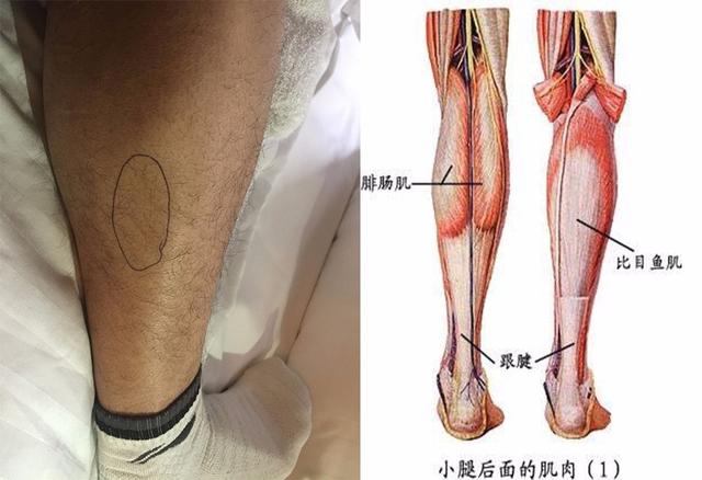 跟腱痛的康复训练和治疗方法-第9张图片-体能网