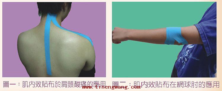 肌内效贴布在运动损伤中的作用-第1张图片-体能网 肌内效贴布在运动损伤中的作用-第1张图片-体能网