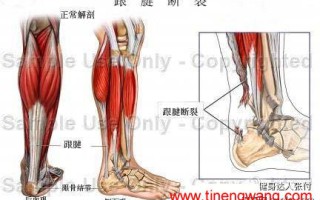 跟腱断裂,韧带断裂与开放性骨折辨析 跟腱断裂,韧带断裂与开放性骨折辨析