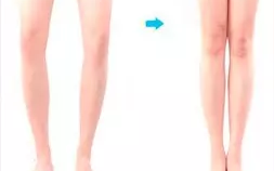 O型腿:跑步易伤吗? O型腿:跑步易伤吗?