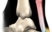 跟腱炎的治疗和康复训练 跟腱炎的治疗和康复训练
